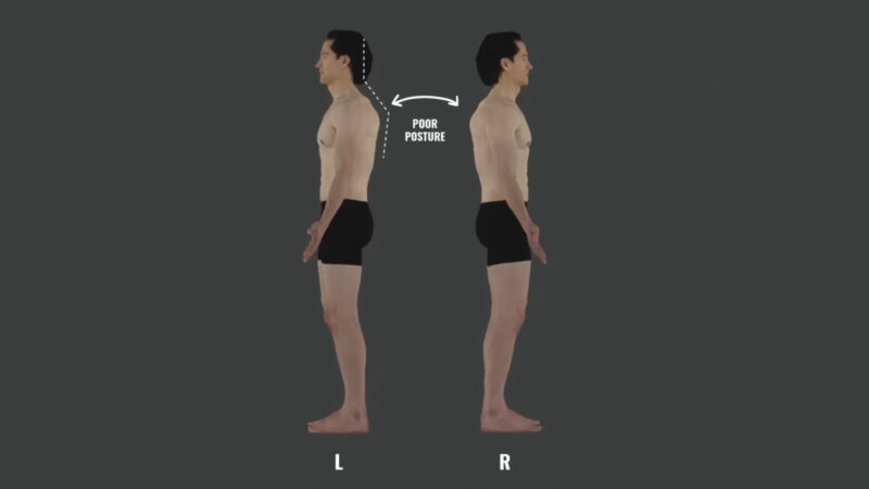 Common Postural Problems - what is a poor posture